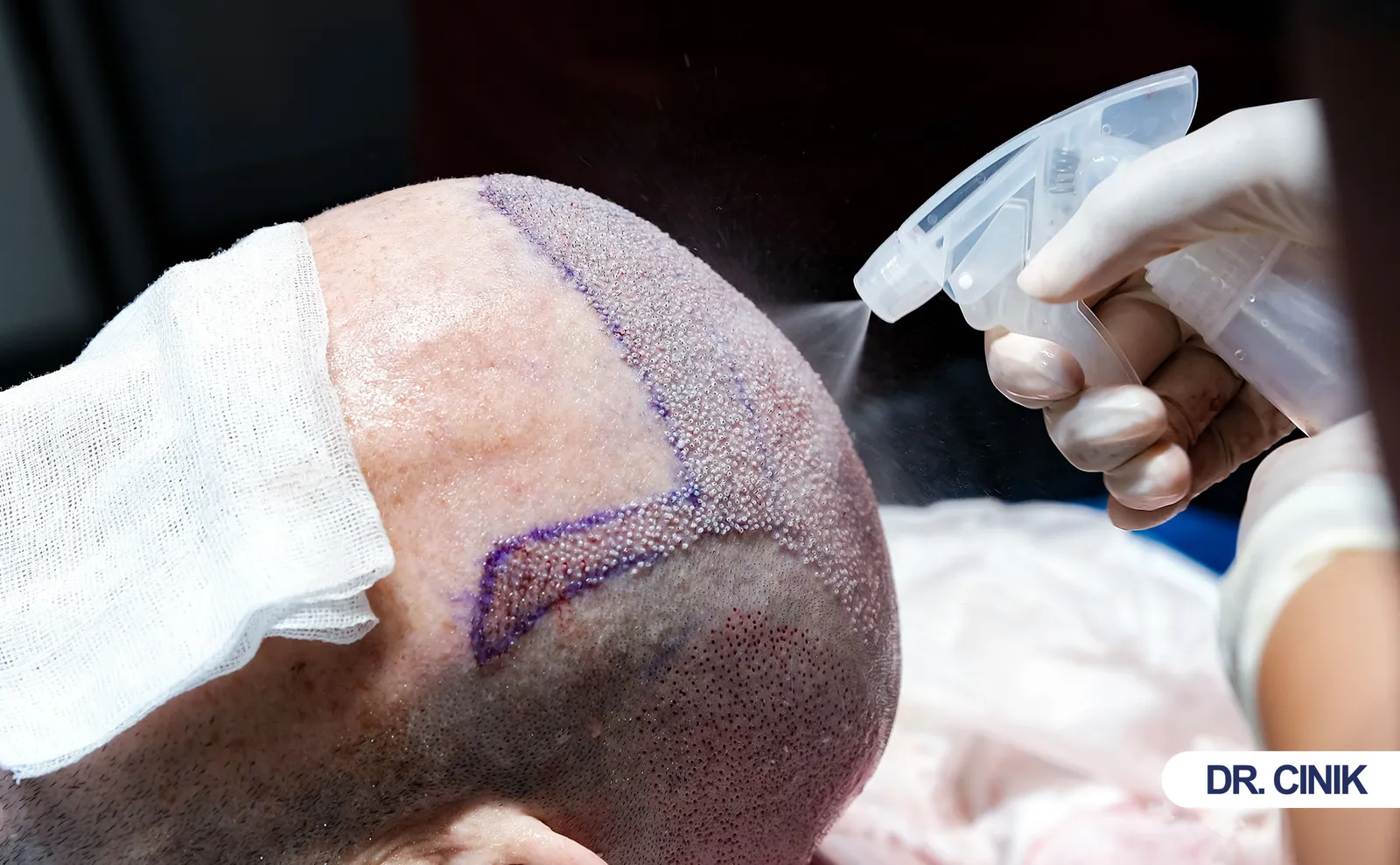 hair transplant