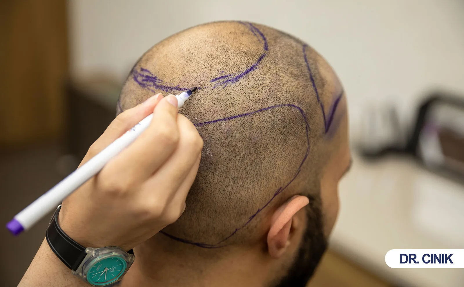 hair transplant