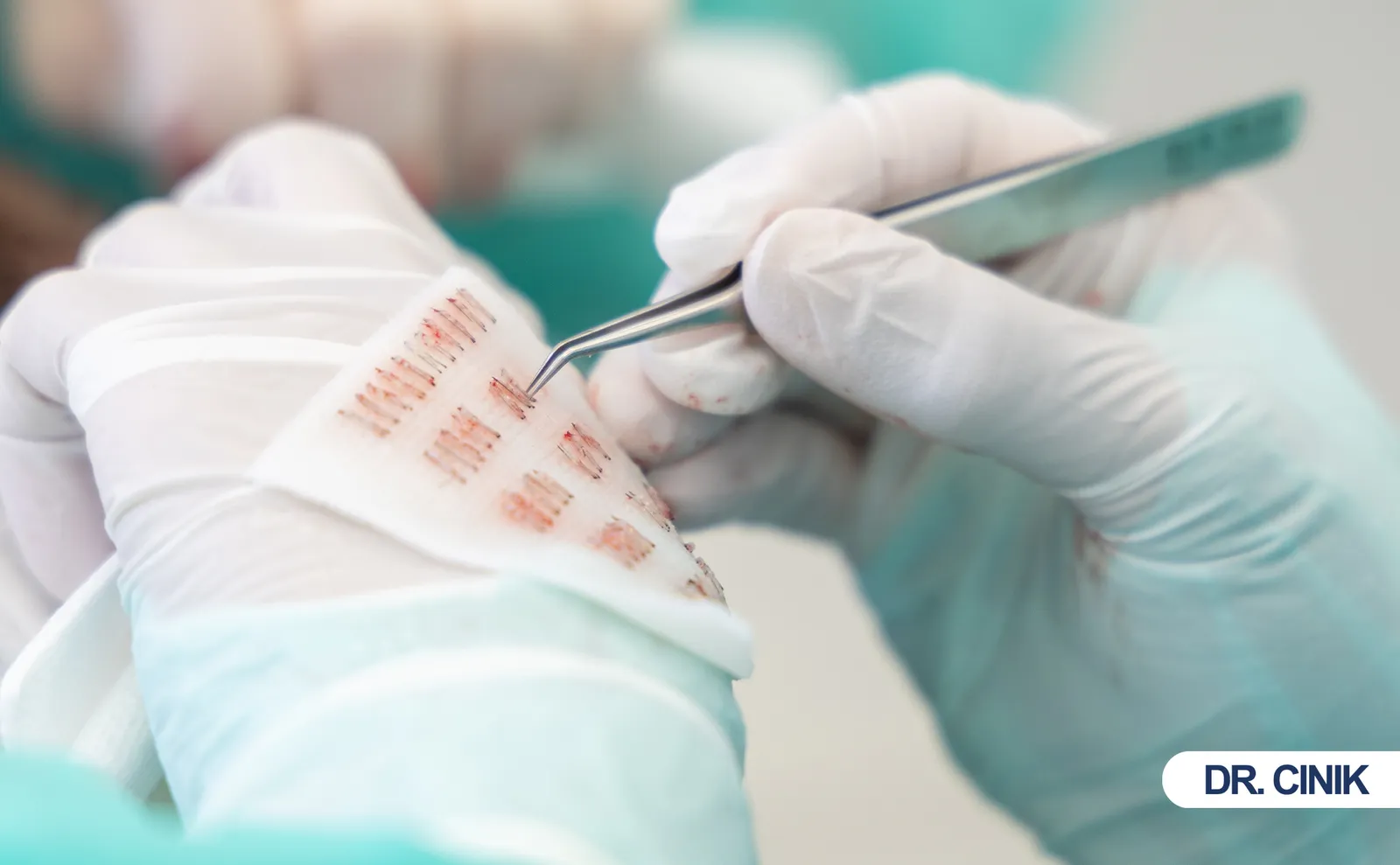 What Is A Hair Graft? Understanding Hair Grafts In Hair Transplant Surgery