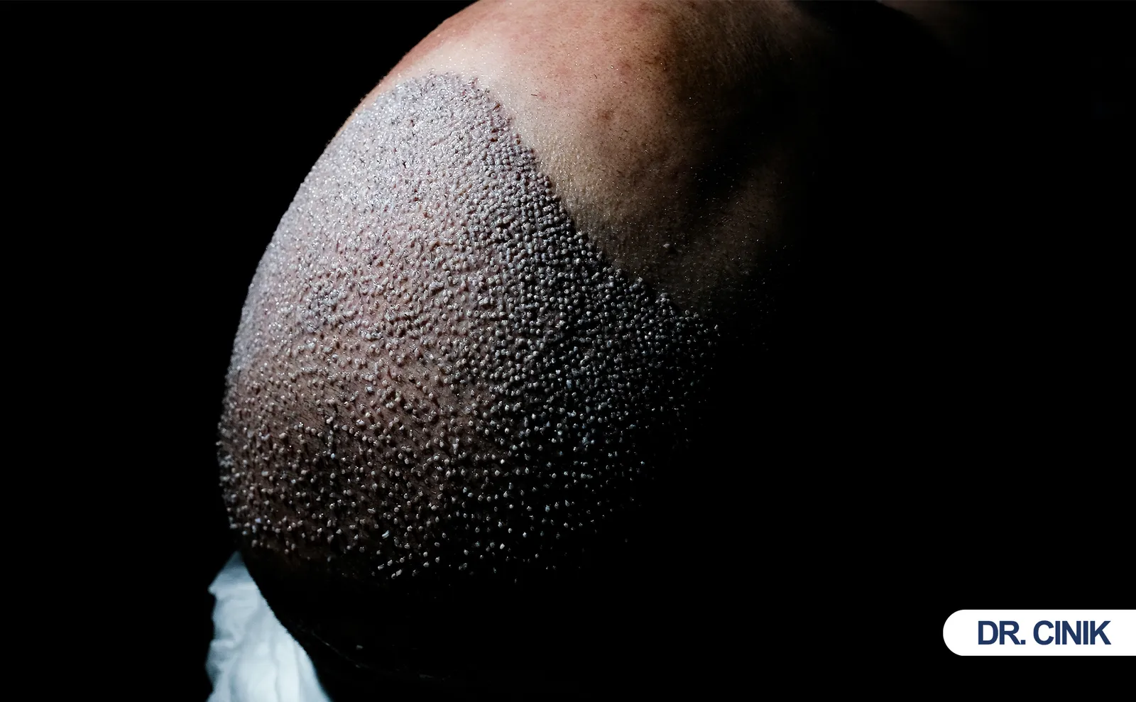 What Should Every Patient Know About Folliculitis After Hair Transplant Surgery?