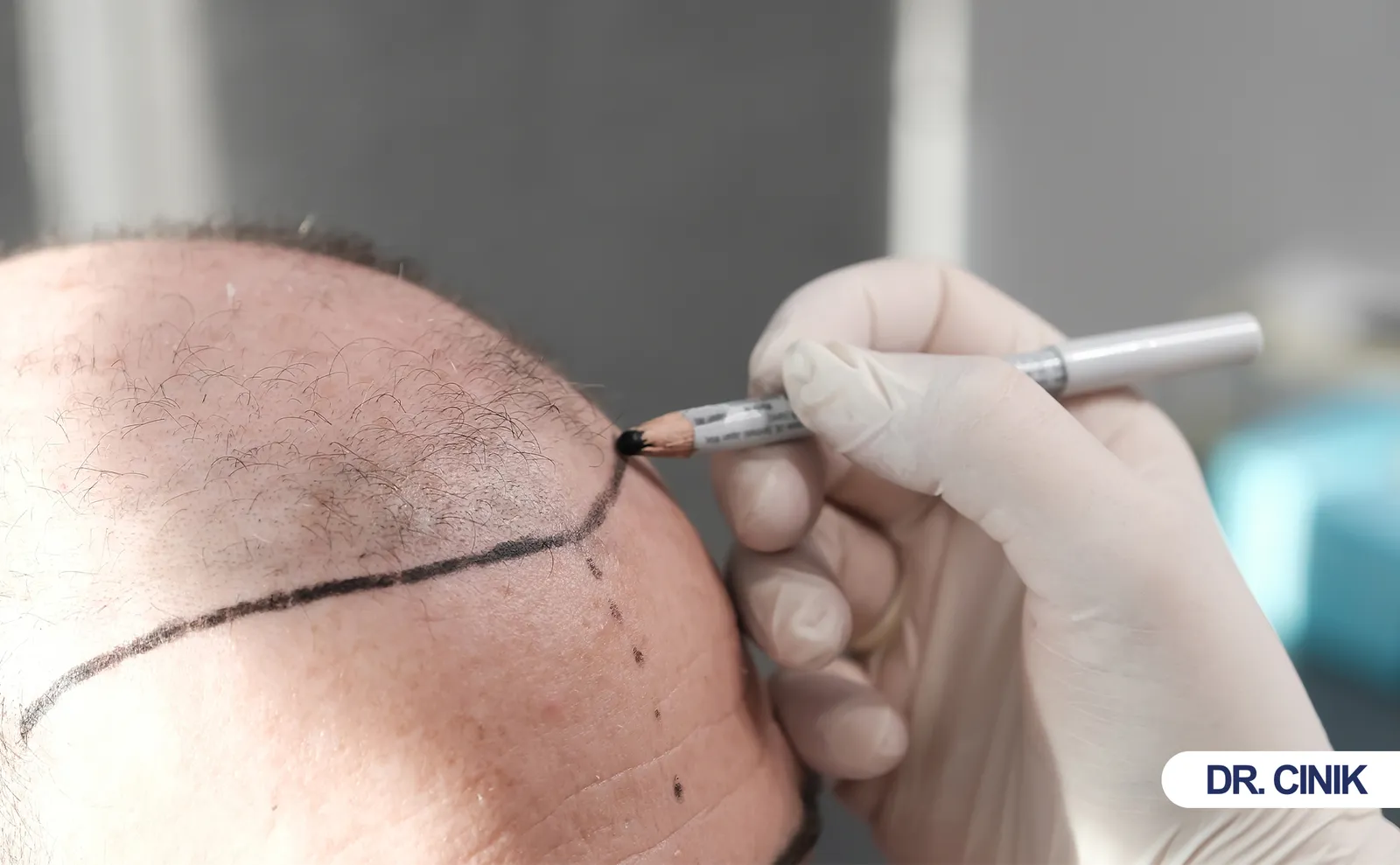 hair transplant