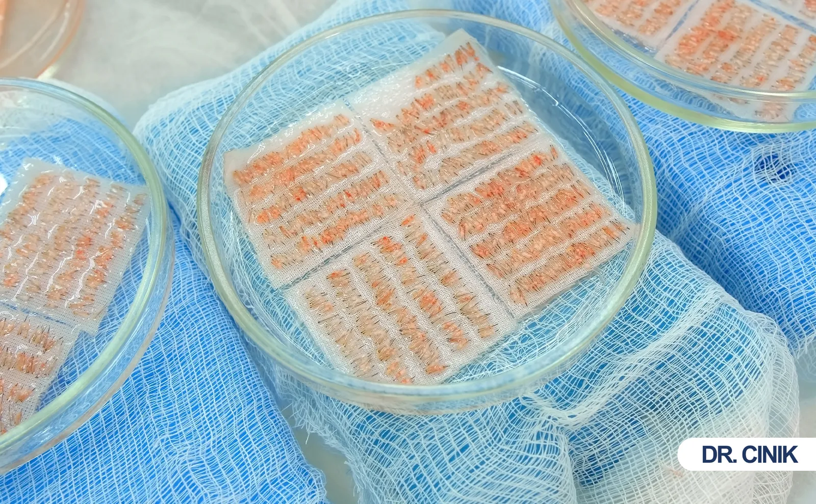hair graft