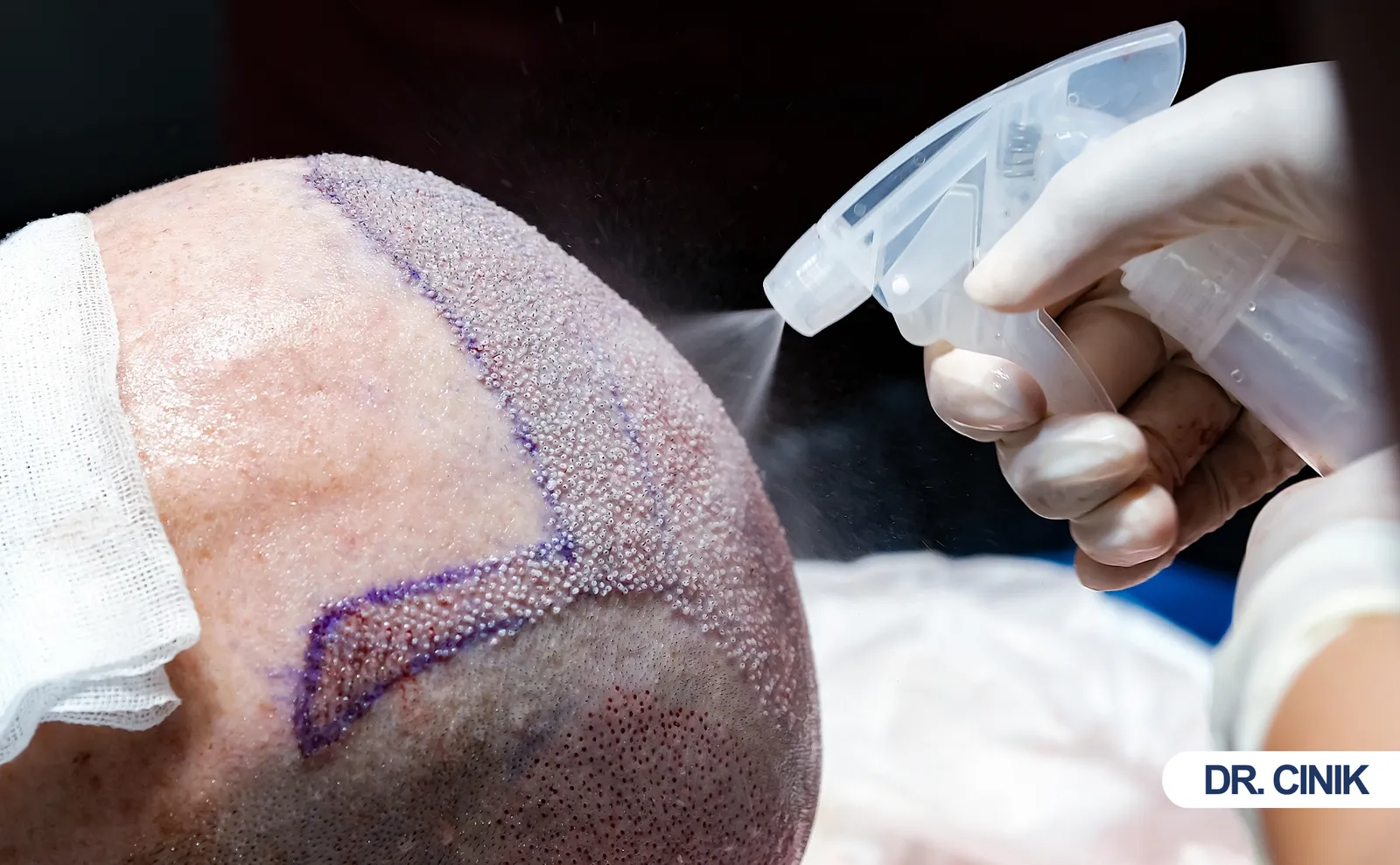 Folliculitis
