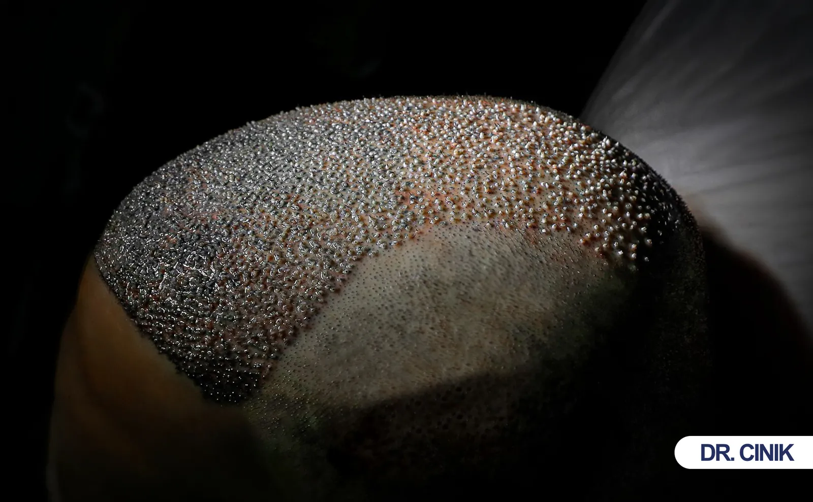 hair transplant