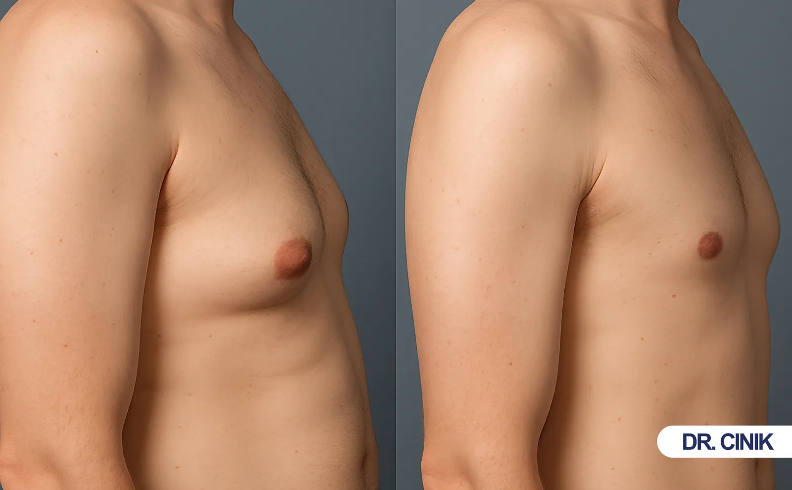 Gynecomastia