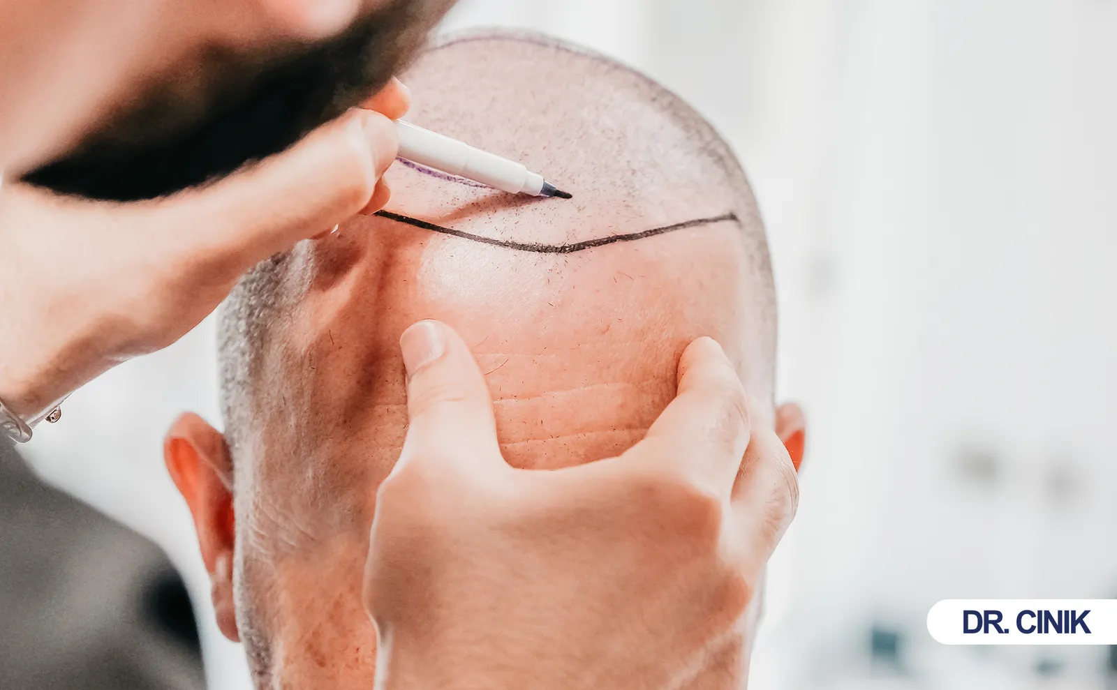 hair transplant