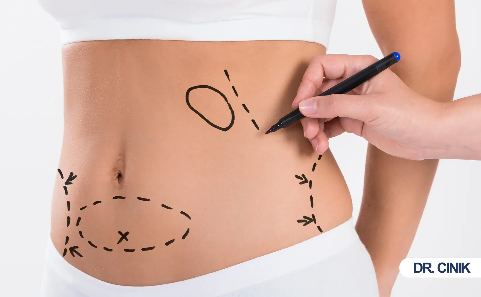 liposuction