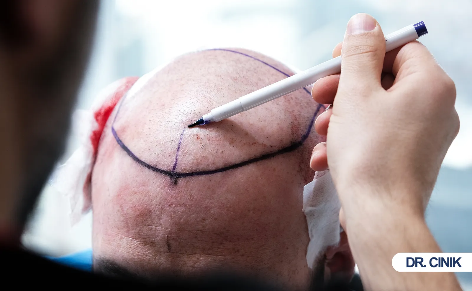 Folliculitis