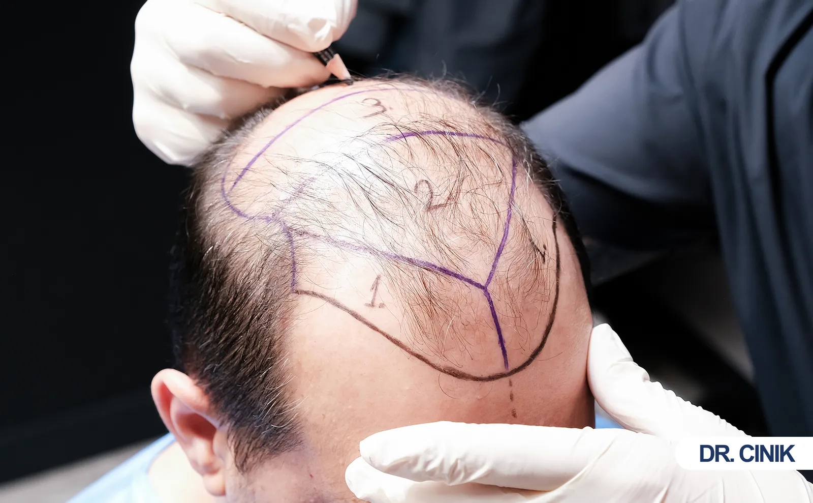 Hair Transplant After 10 Years: What Happens to Transplanted Hair Over Time?