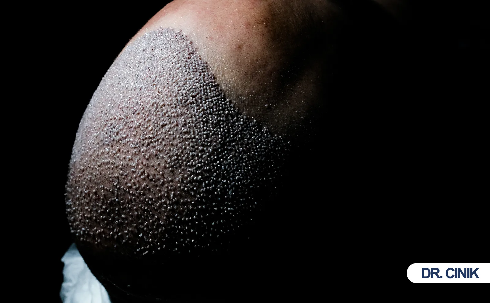 hair transplant