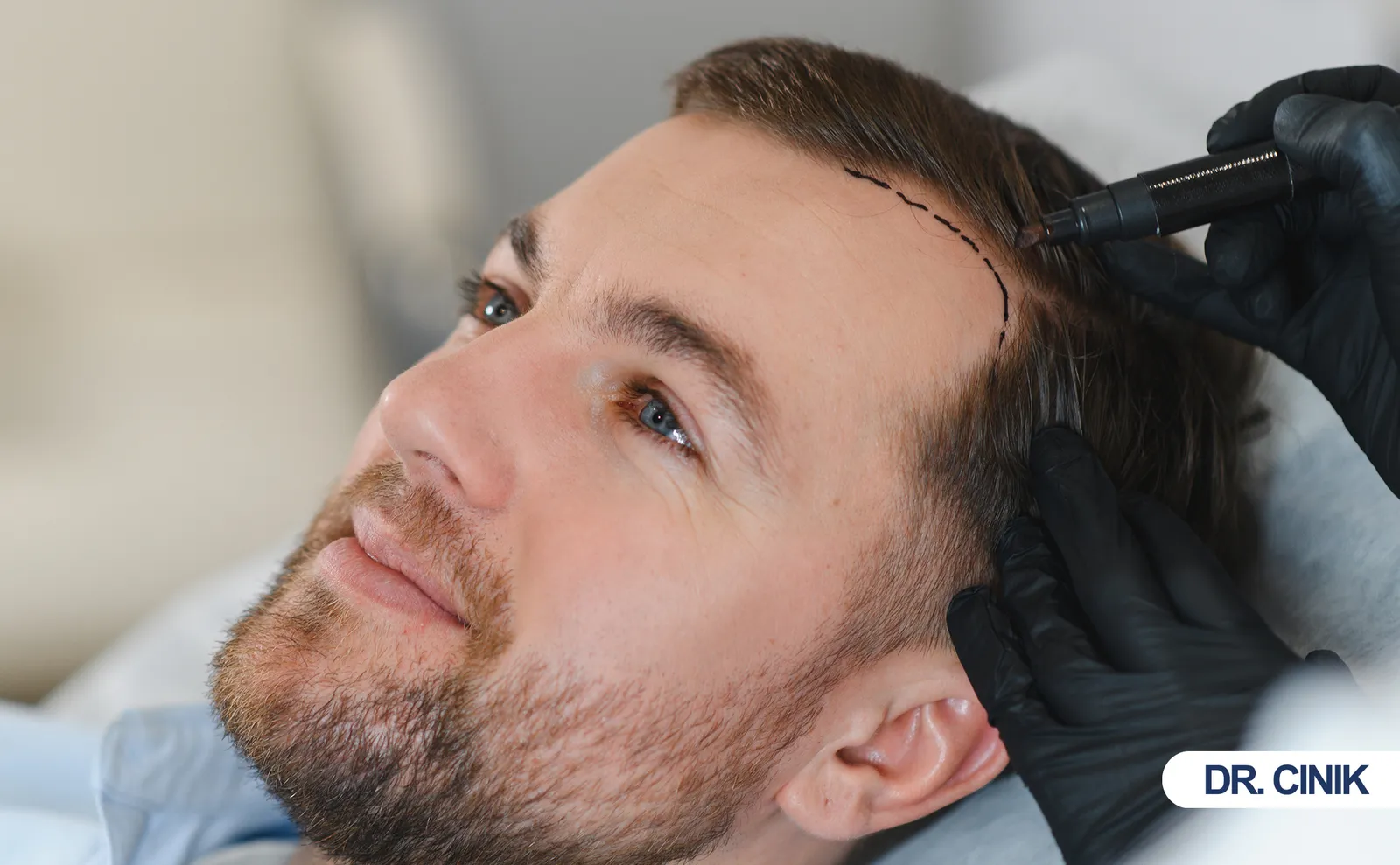 hair transplant