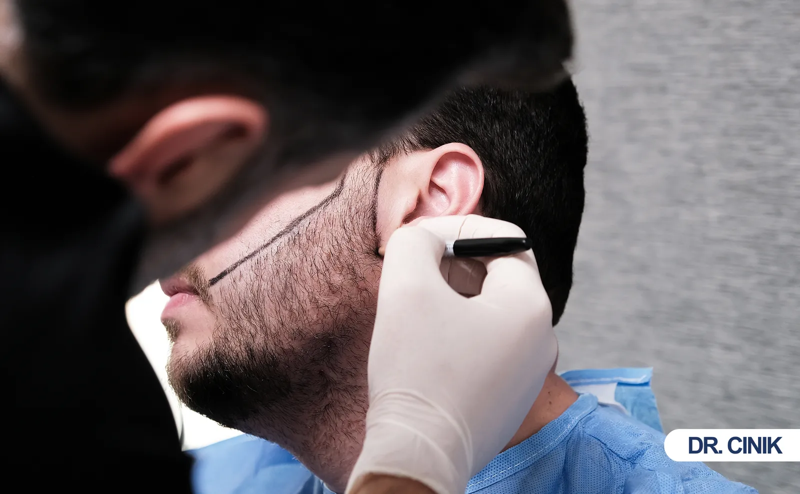 What Should Men Know About Beard Transplant Surgery?