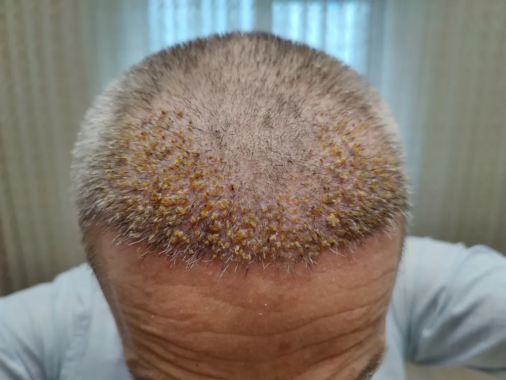 What Are Hair Transplant Scabs and Why Do They Form?