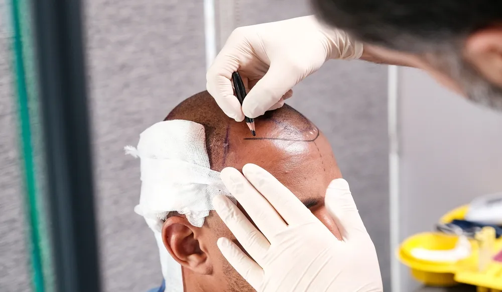 What Is Overharvesting in Hair Transplantation and Why Does It Threaten Long-Term Results?