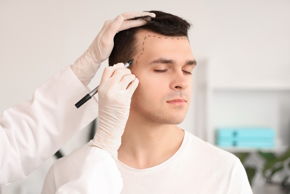 Why Is Turkey the Global Leader in FUE Hair Transplant?