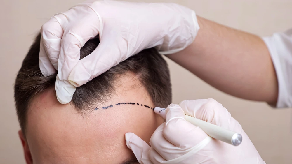 Answers to Hair Transplant Questions: A Complete Scientific FAQ Guide