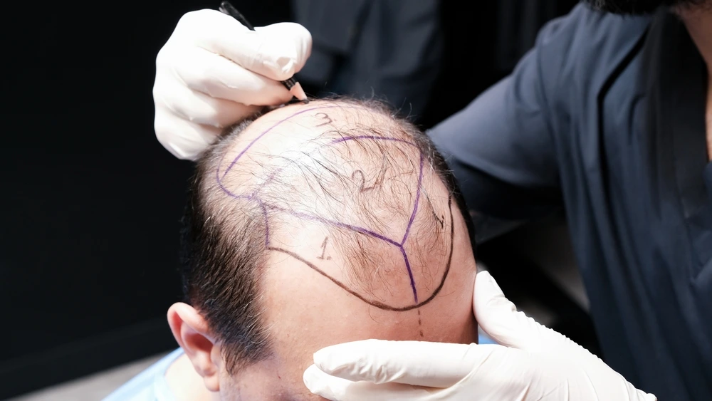 What Are the Hair Transplant Statistics for 2026?