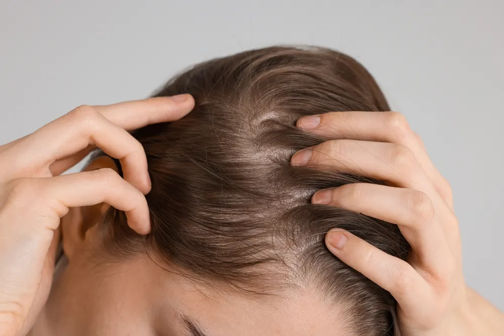 The Truth About Shock Loss: What Really Happens After a Hair Transplant