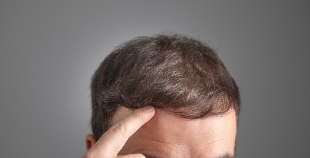 What Is the Best Age for a Hair Transplant?