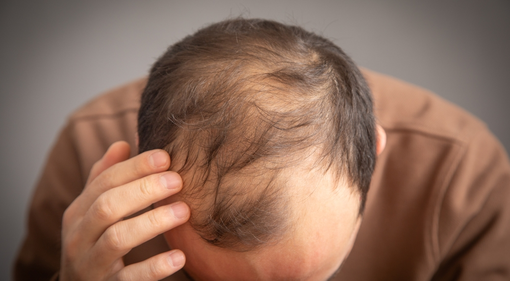 PP405 Hair Loss Treatment: Mechanism, Clinical Trials, Results, and Future of Regenerative Hair Restoration