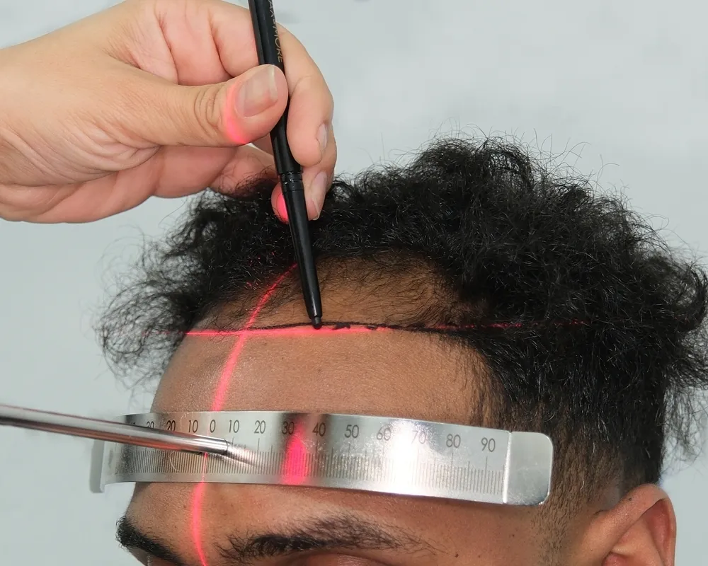 DHI Hair Transplant in Turkey: Everything You Need to Know