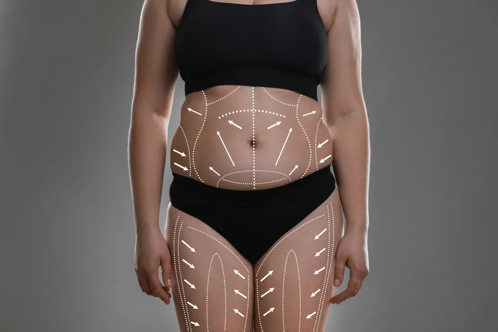 VASER Liposuction vs Traditional Liposuction: What's the Difference?