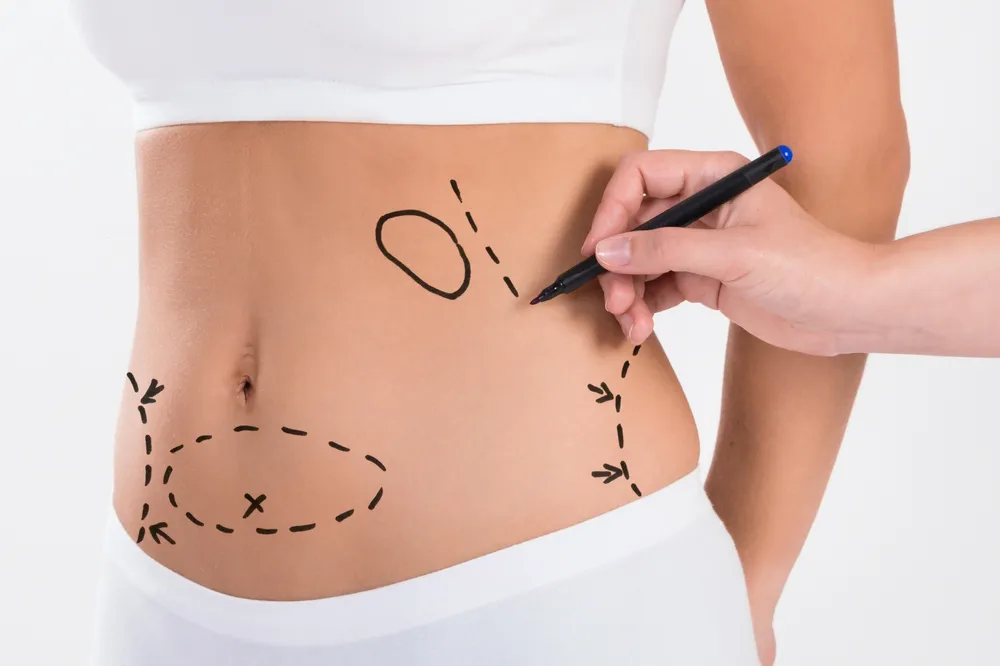 Is Liposuction a Weight Loss Procedure? Understanding the Facts Behind Body Contouring