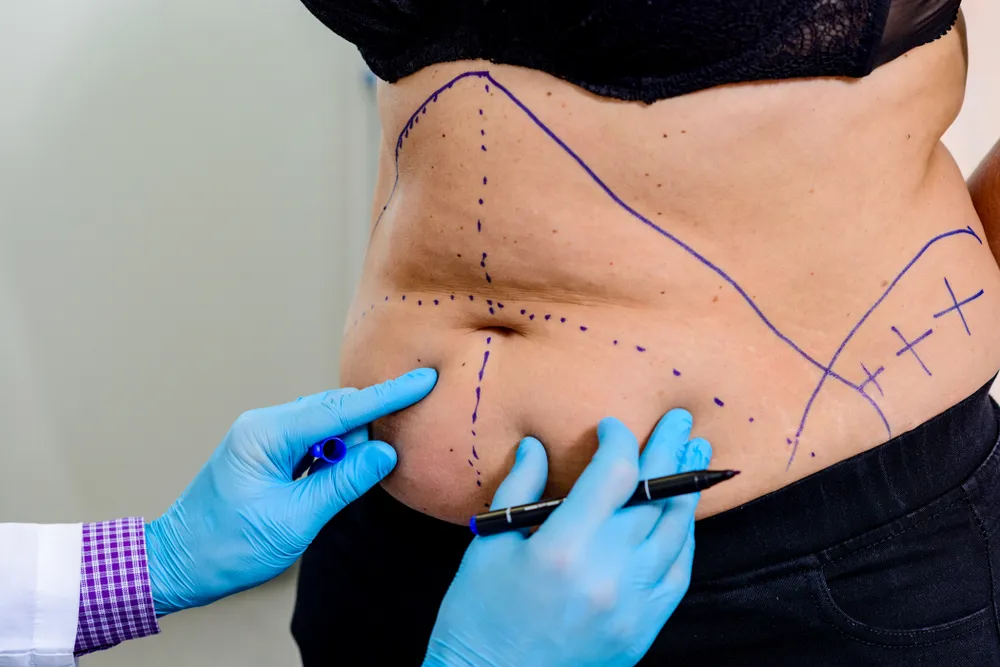 How Soon Can You Exercise After a Tummy Tuck?
