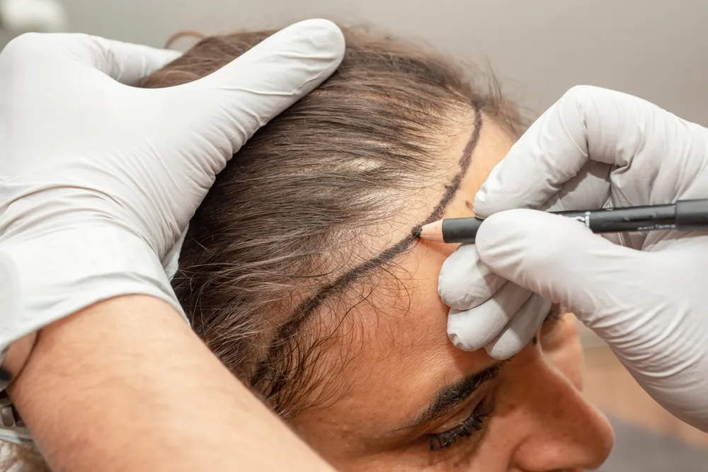 What Women Should Know Before Getting a Hair Transplant in Turkey
