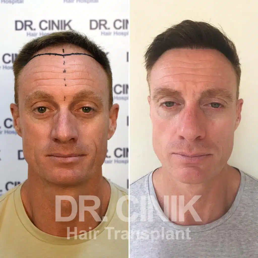Norwood IV - DHI - Before / After