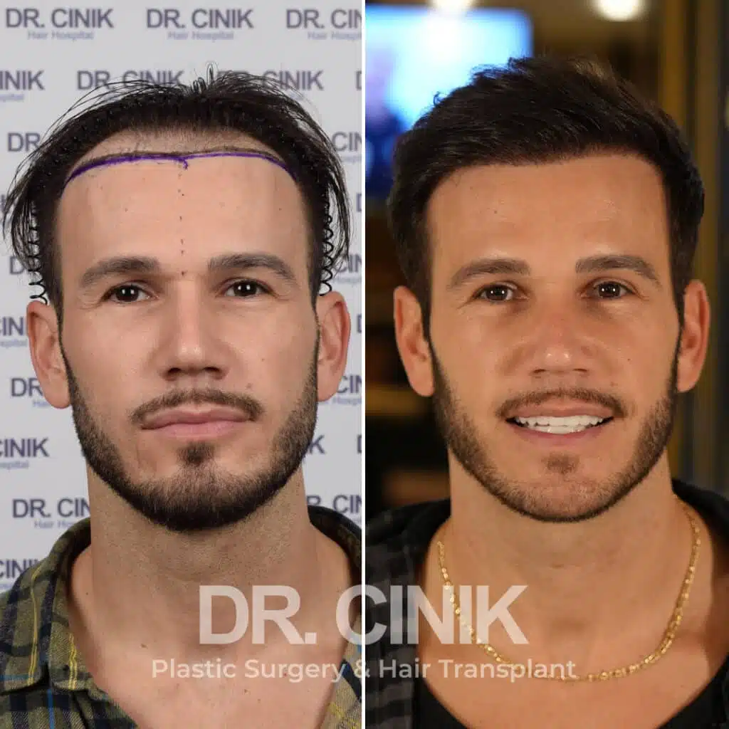 Norwood IV - Sapphire FUE - Before / After