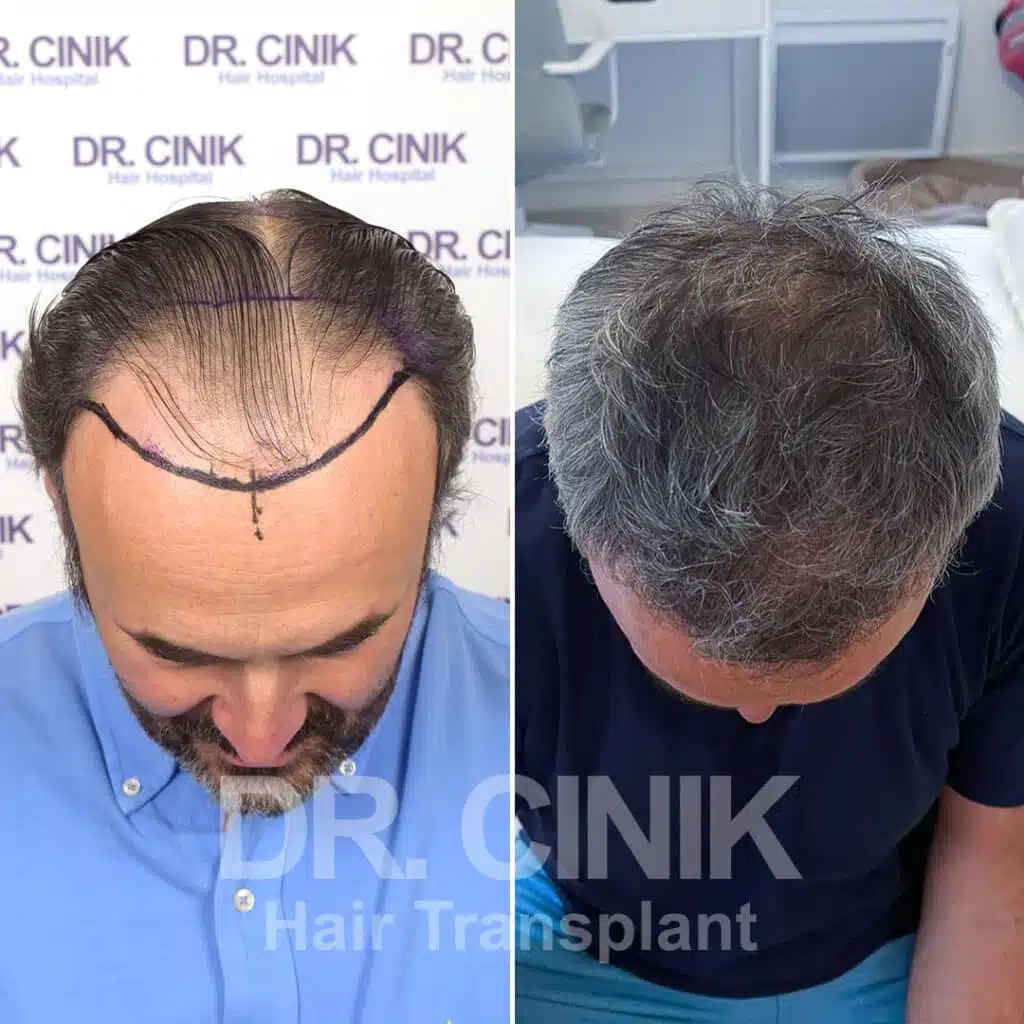 Norwood V - FUE - Before / After