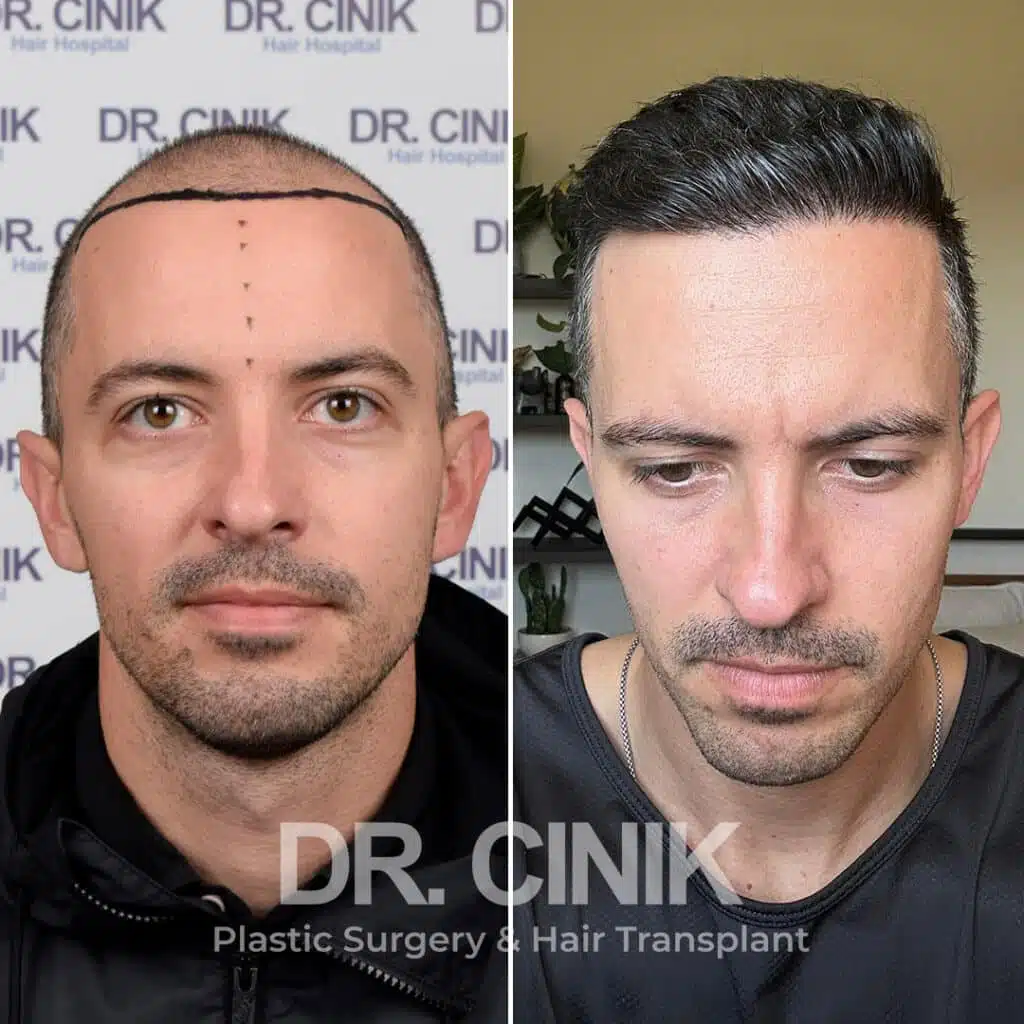 Norwood IV - Sapphire FUE - Before / After