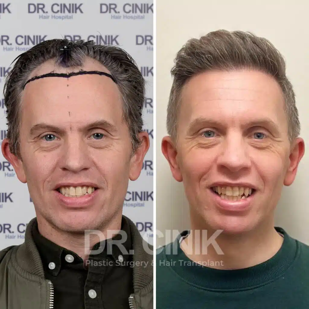 Norwood IV - Sapphire FUE - Before / After