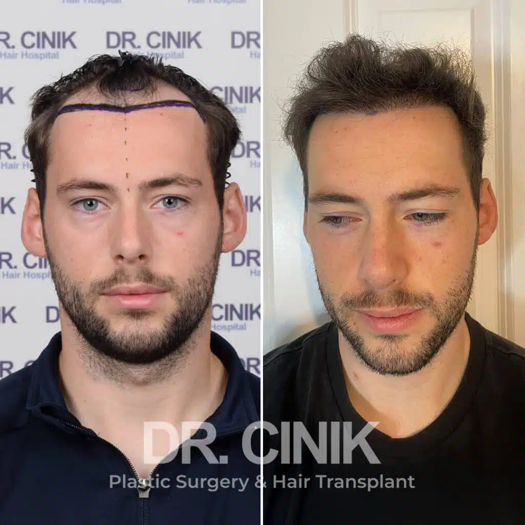 Norwood III - DHI - Before / After