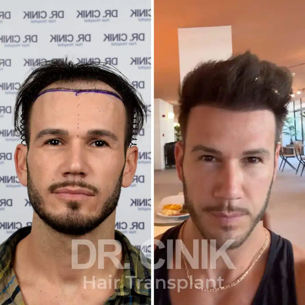 Norwood IV - FUE - Before / After
