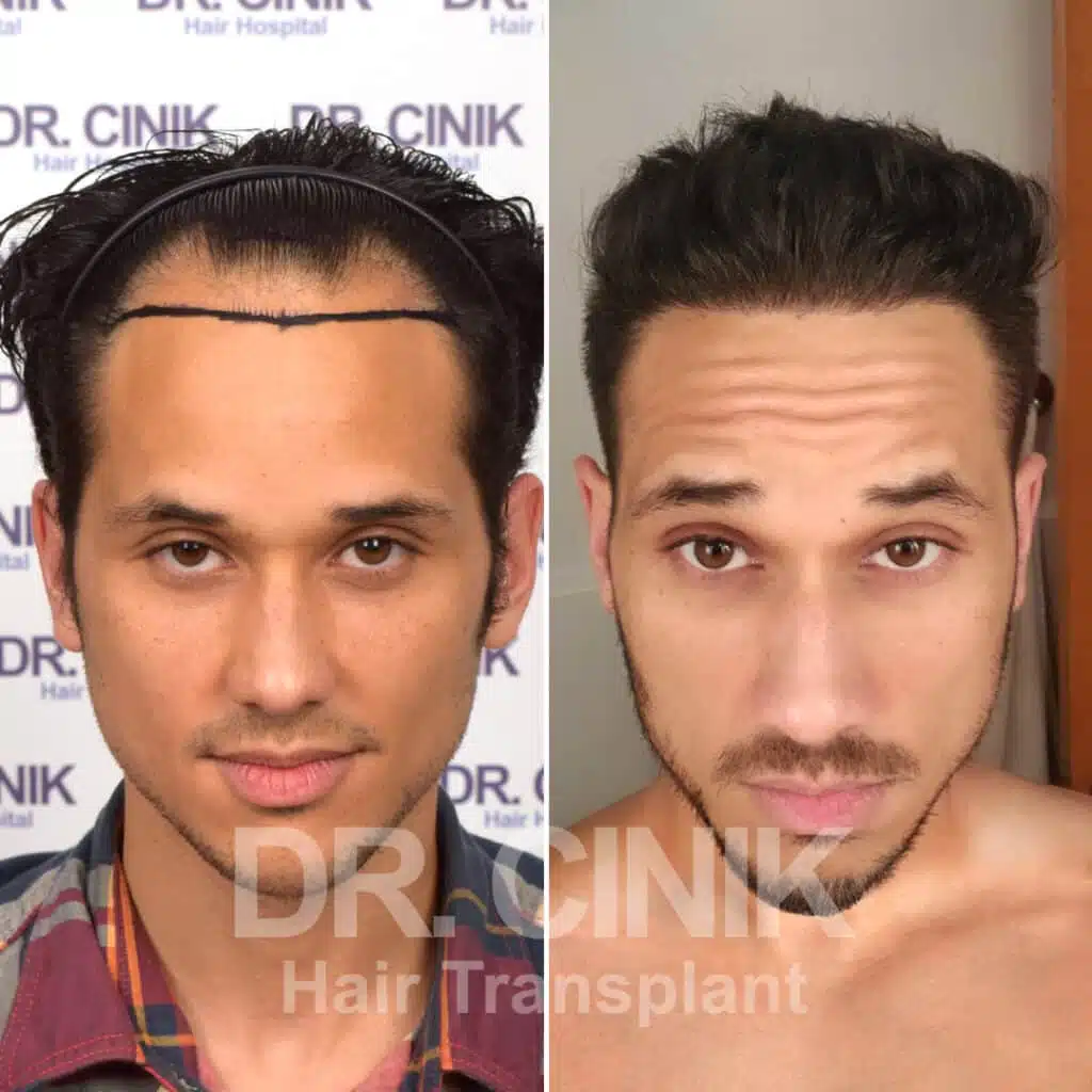 Norwood V - Sapphire FUE - Before / After