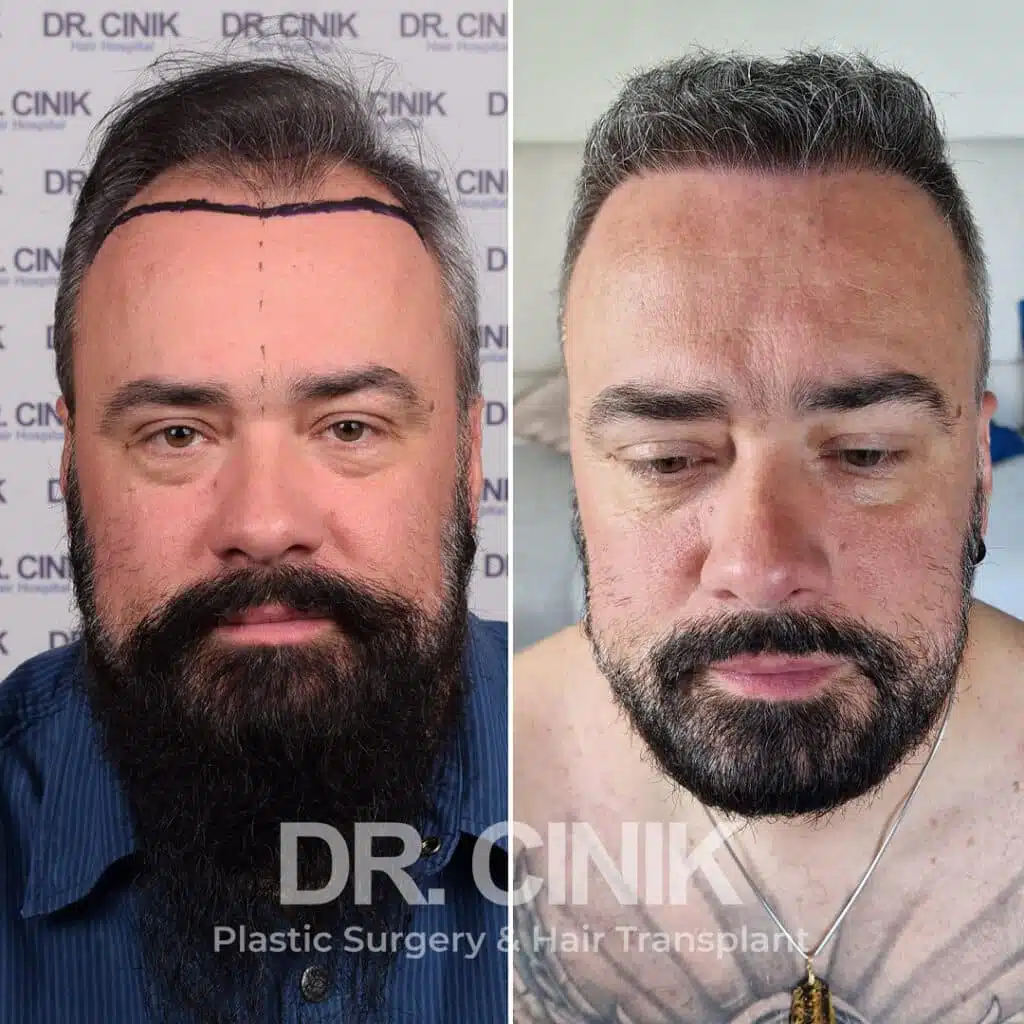 Norwood V - FUE - Before / After