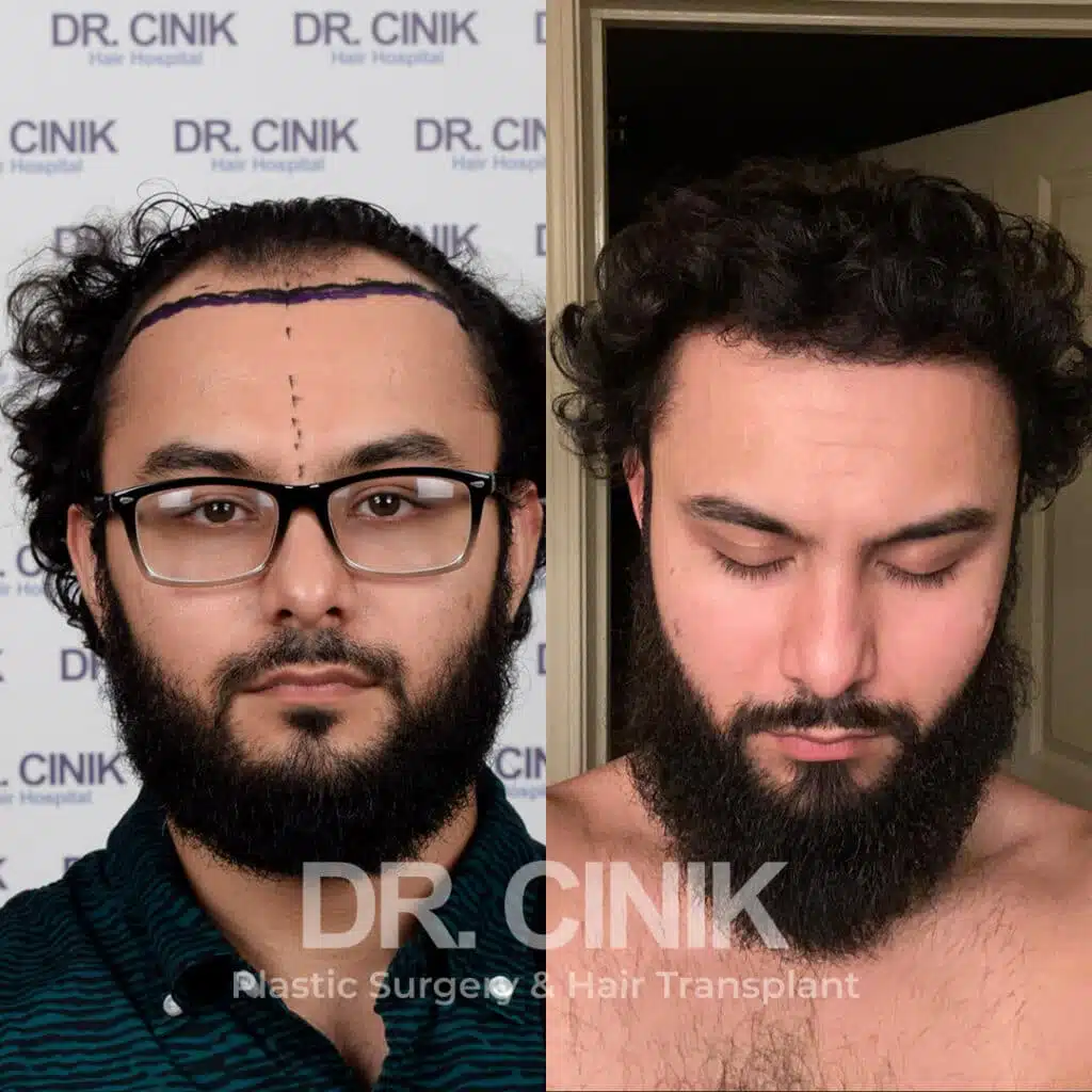 Norwood V - Sapphire FUE - Before / After