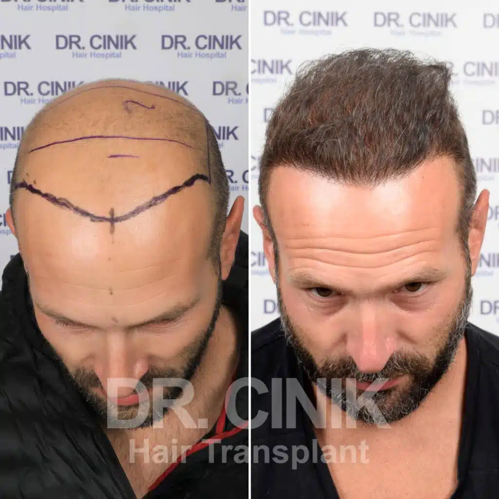 Beard transplant - FUE - Before / After