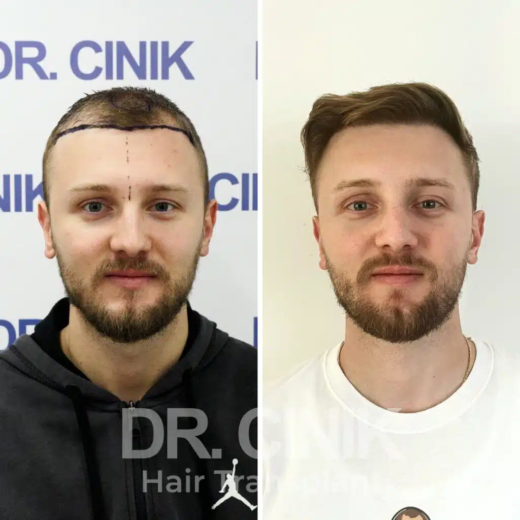 Norwood III - DHI - Before / After