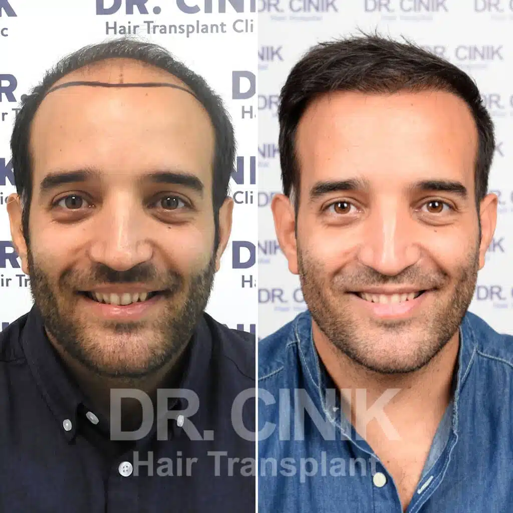 Norwood V - FUE - Before / After
