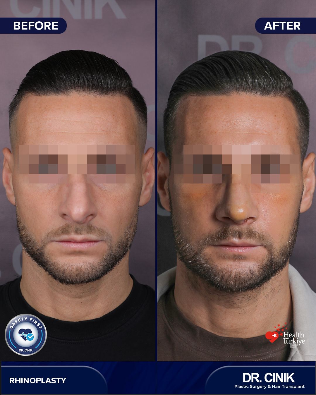 Before and after — Case Nº 142