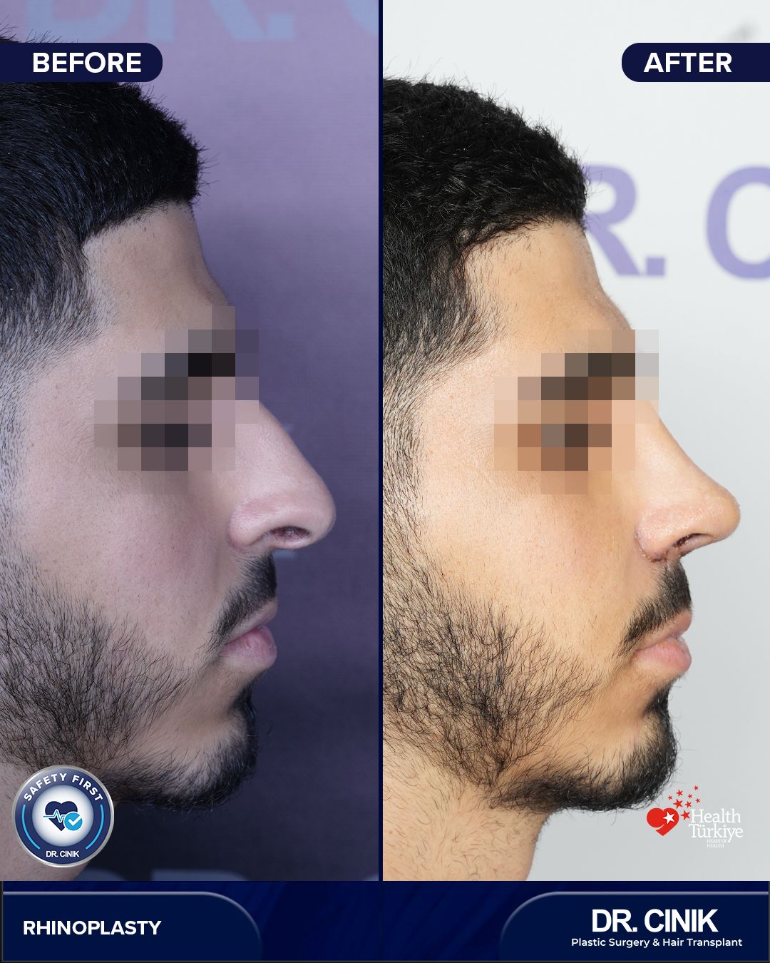 Before and after — Case Nº 334