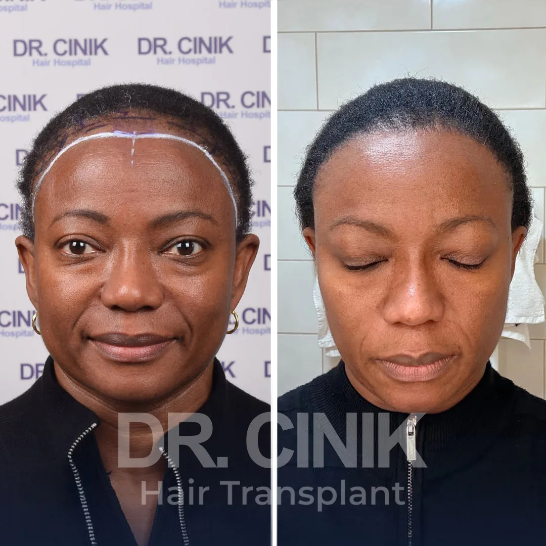 Hair Transplant
