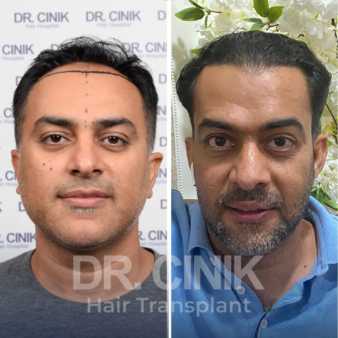Hair Transplant
