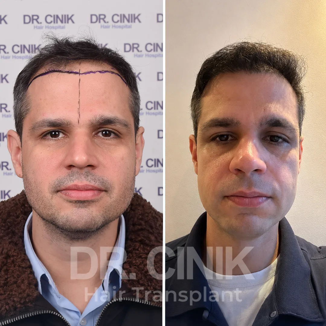 Haartransplantation