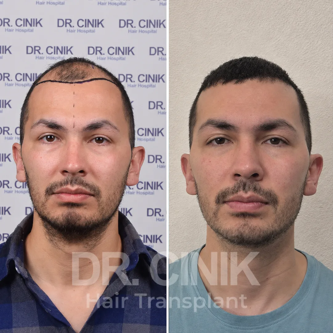 Haartransplantation