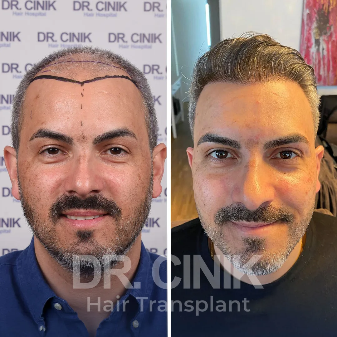 Hair Transplant