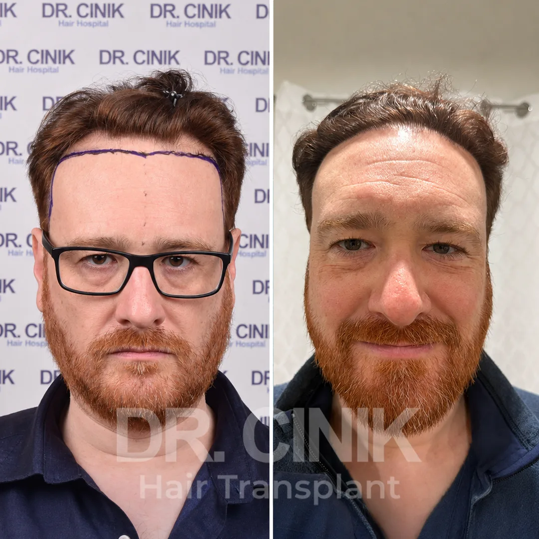Haartransplantation